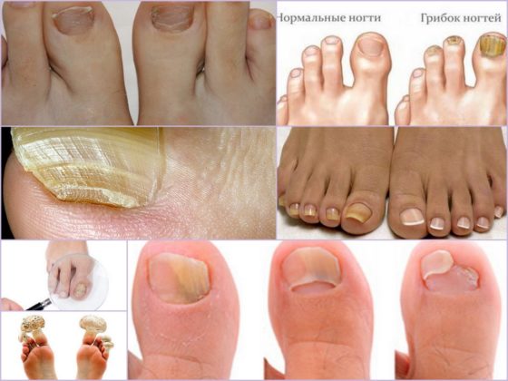 лікування грибка нігтів на ногах оцтом