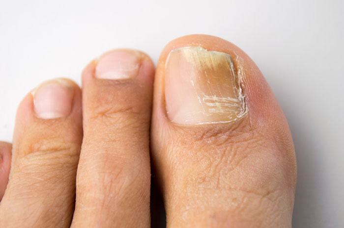 грибок на нігтях ніг фото