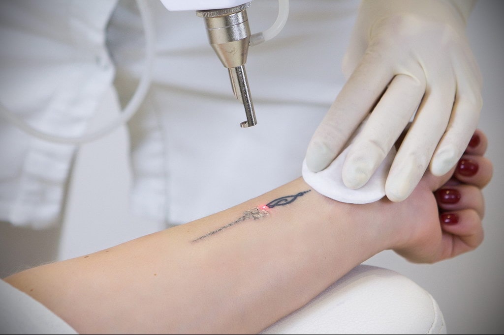 Лазерное удаление татуировок – описание способа и его особенностей - tatufoto.com