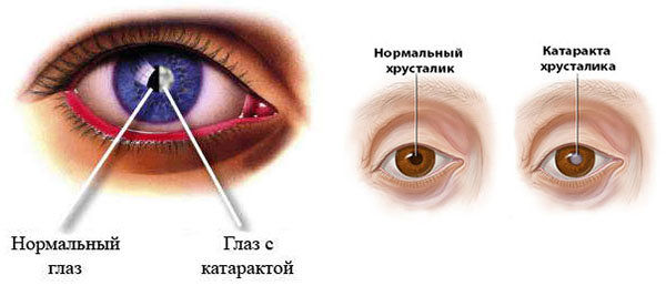катаракта очей