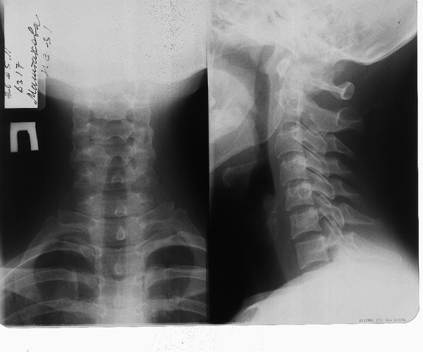 Остеохондроз на рентгенівському знімку