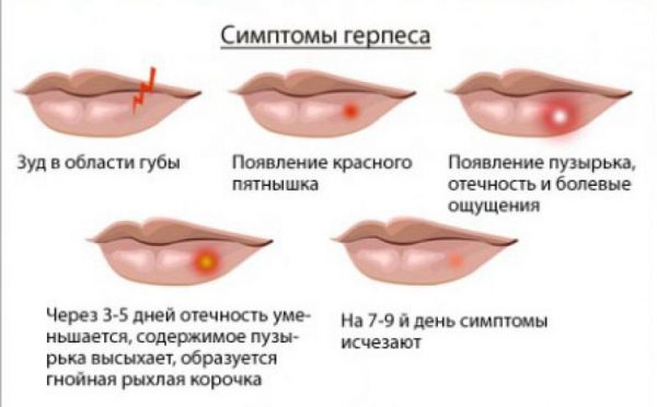 герпес на губах симптоми