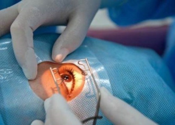 глаукома очей лікування
