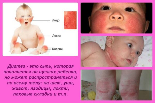 діатез у новонароджених