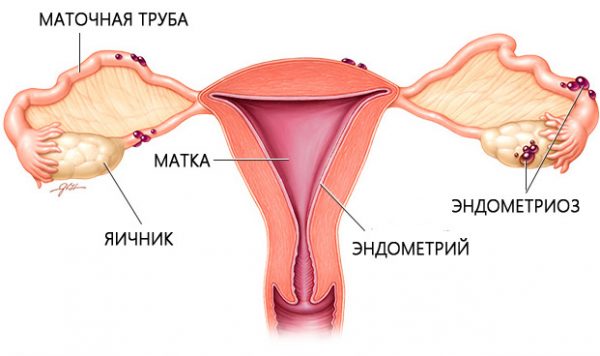 ендометріоз тіла матки