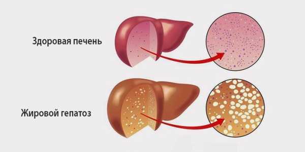 жировий гепатоз печінки