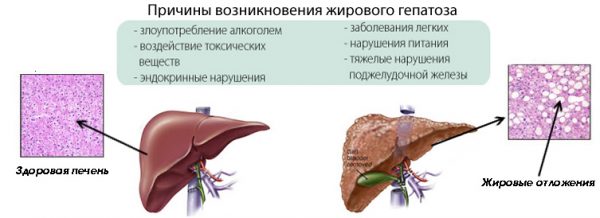 жировий гепатоз печінки