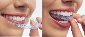 пластини для вирівнювання зубів