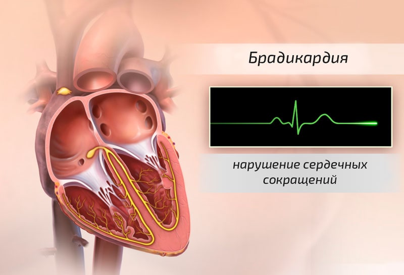 брадикардія серця причини винекнення
