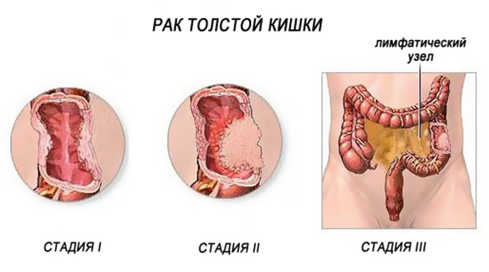 пухлина кишечника симптоми
