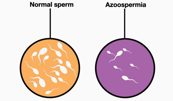 Азооспермія
