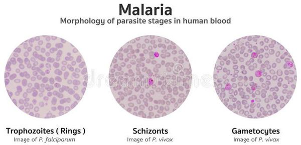 малярія за ступенем тяжкості