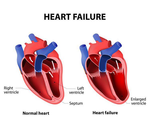 Патогенез серцевої недостатност