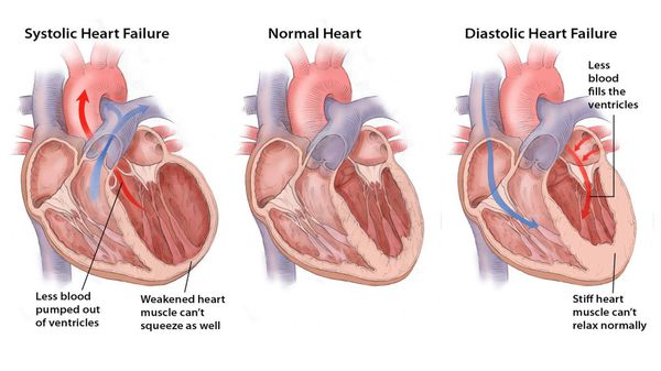 Хронічна серцева недостатність з порушенням