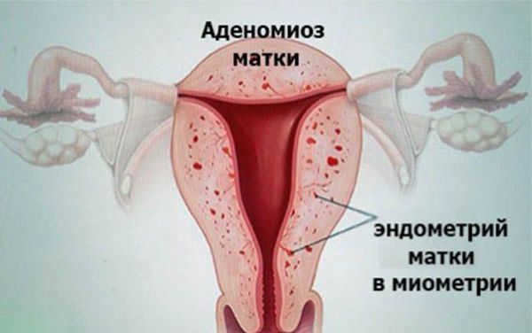 аденоміоз матки