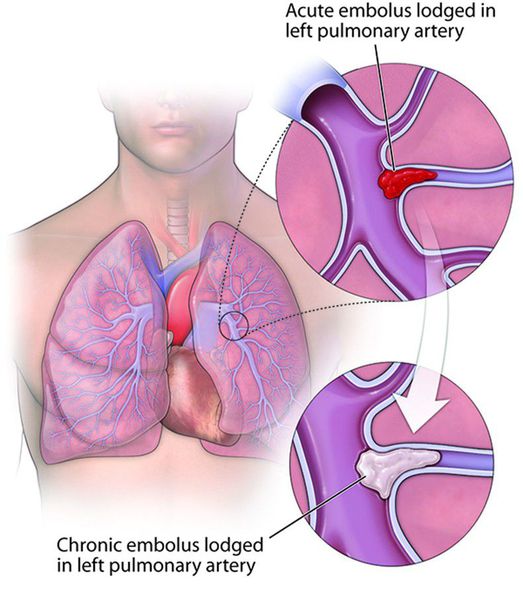 Хронічна тромбоемболічна легенева гіпертензія