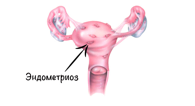 ендометріоз у жінок після 40