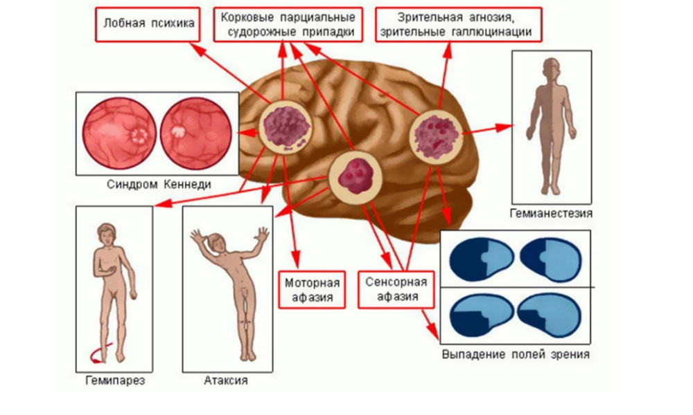 пухлина в мозку симптоми