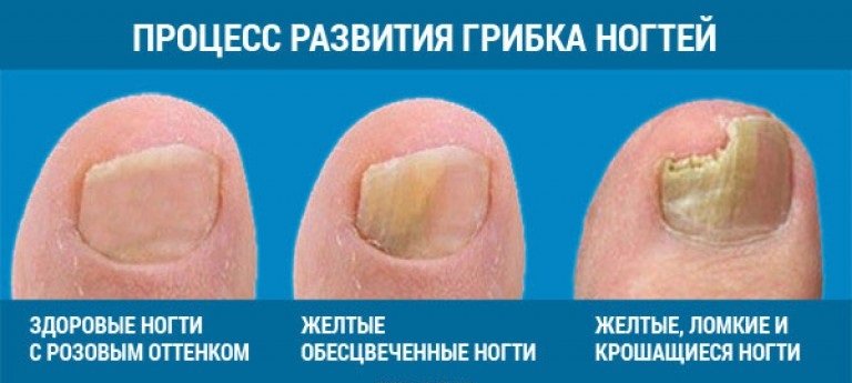 як лікувати грибок на нігтях ніг форум